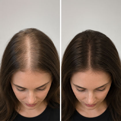 زراعة الشعر للنساء