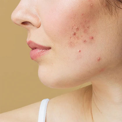 Acne Treatment in Dubai