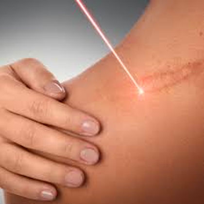 Laser Scar Removal