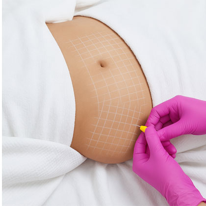Lipolysis Treatment