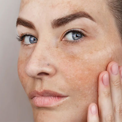 Melasma Treatment
