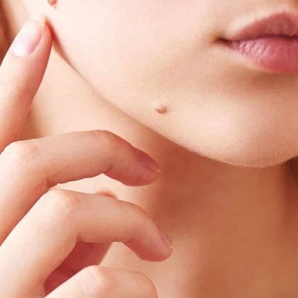 Mole Removal Treatment in Dubai