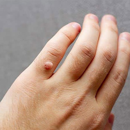Wart Removal