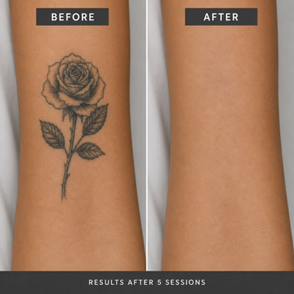 Tattoo Removal Cost In Dubai