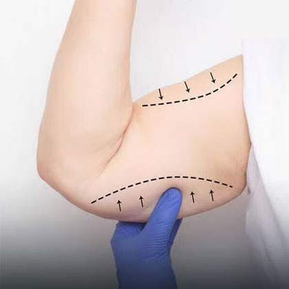 Arm Lift Surgery in Dubai