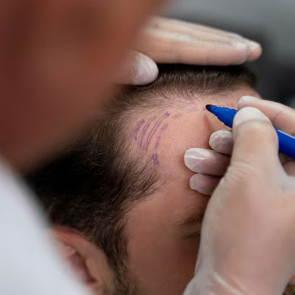 DHI Hair Transplant