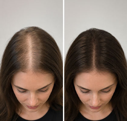 Female Hair Transplant Cost in Dubai