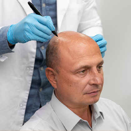 Stem Cell Hair Transplant