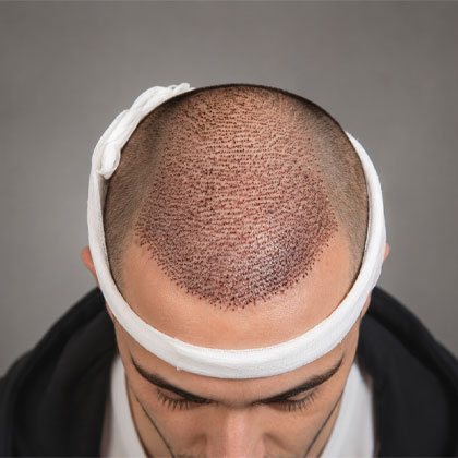 FUE Hair Transplant In Dubai