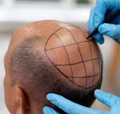 Hair Transplant Cost In Dubai