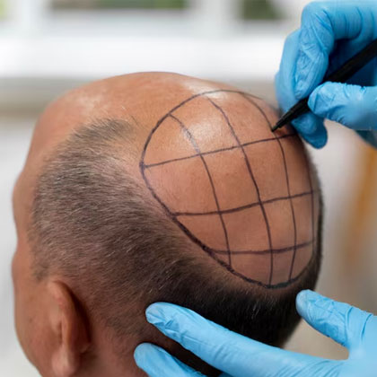 Hair Transplant Cost In Dubai