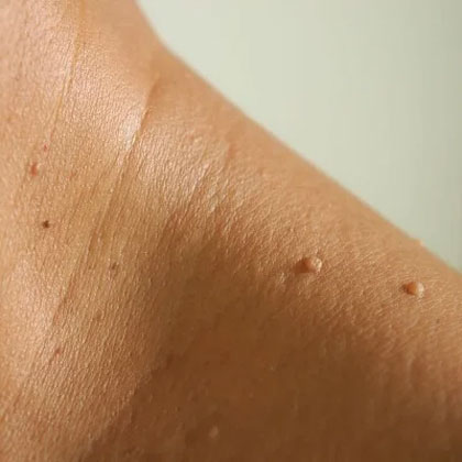 Skin Tag Removal
