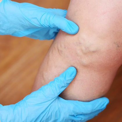 Spider Vein Treatment